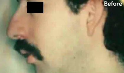 Rhinoplasty Male Before & After Patient #3036