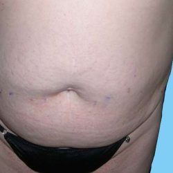 Tummy Tuck Before & After Patient #3075