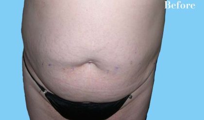 Tummy Tuck Before & After Patient #3075