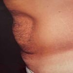 Tummy Tuck Male Before & After Patient #3087