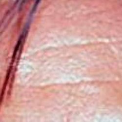 Botox Before & After Patient #2157