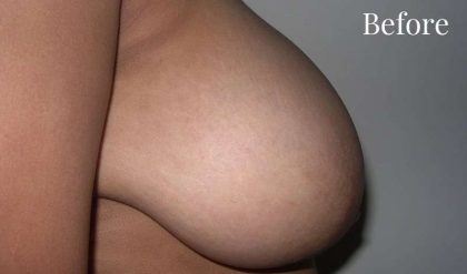 Breast Reduction Before & After Patient #2360
