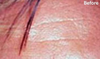 Botox Before & After Patient #2157