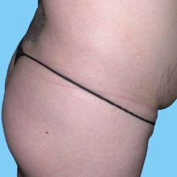 Buttock Augmentation Before & After Patient #2456