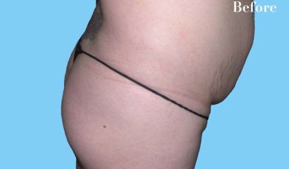 Buttock Augmentation Before & After Patient #2456