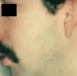 Chin Implants Before & After Patient #2480