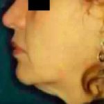 Chin Liposuction Before & After Patient #2492