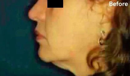 Chin Liposuction Before & After Patient #2492