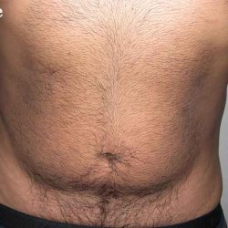 Daddy Makeover Before & After Patient #2524