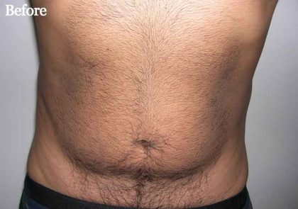 Daddy Makeover Before & After Patient #2524