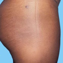 Buttock Augmentation Before & After Patient #2408