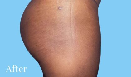 Buttock Augmentation Before & After Patient #2408