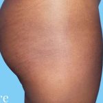 Buttock Augmentation Before & After Patient #2408