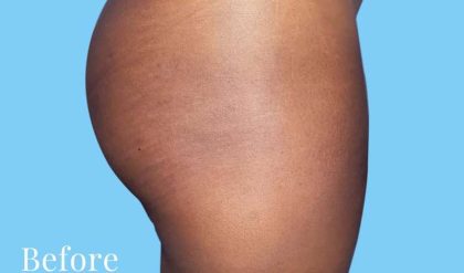 Buttock Augmentation Before & After Patient #2408