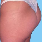 Buttock Augmentation Before & After Patient #2396