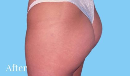 Buttock Augmentation Before & After Patient #2396