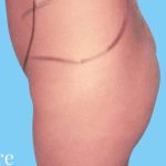 Buttock Augmentation Before & After Patient #2396