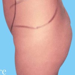 Buttock Augmentation Before & After Patient #2396