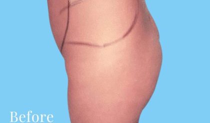 Buttock Augmentation Before & After Patient #2396