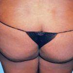 Buttock Augmentation Before & After Patient #2459