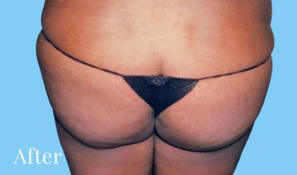 Buttock Augmentation Before & After Patient #2459