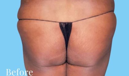 Buttock Augmentation Before & After Patient #2459