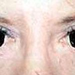 Eyelid Surgery Before & After Patient #2626