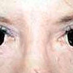 Eyelid Surgery Before & After Patient #2626