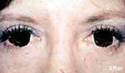 Eyelid Surgery Before & After Patient #2626