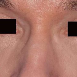 Eyelid Surgery Male Before & After Patient #2638