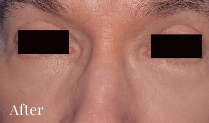 Eyelid Surgery Male Before & After Patient #2638