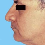 Facelift Male Before & After Patient #2674