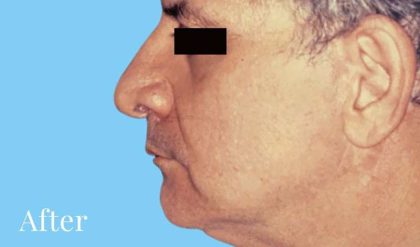 Facelift Male Before & After Patient #2674