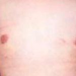 Gynecomastia Before & After Patient #2722