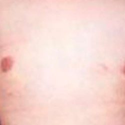 Gynecomastia Before & After Patient #2722