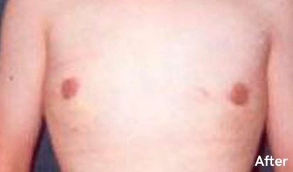 Gynecomastia Before & After Patient #2722