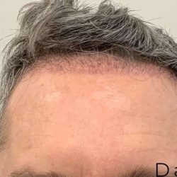 Hair Restoration Before & After Patient #2802