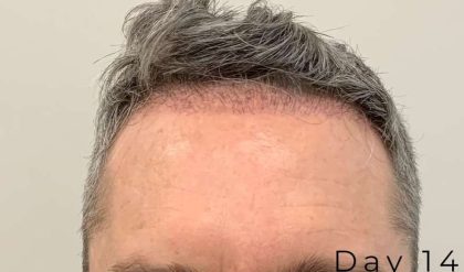 Hair Restoration Before & After Patient #2802