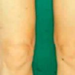 Liposuction Before & After Patient #2885