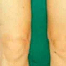 Liposuction Before & After Patient #2885