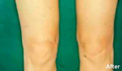 Liposuction Before & After Patient #2885
