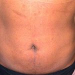 Liposuction Male Before & After Patient #2918