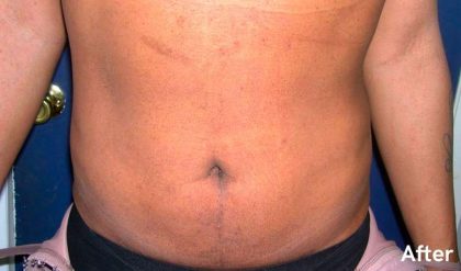 Liposuction Male Before & After Patient #2918