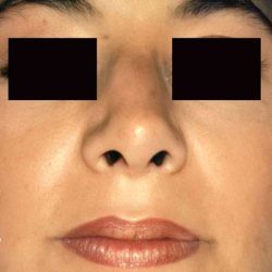 Rhinoplasty Before & After Patient #3003