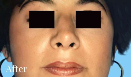Rhinoplasty Before & After Patient #3003