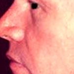 Rhinoplasty Male Before & After Patient #3039