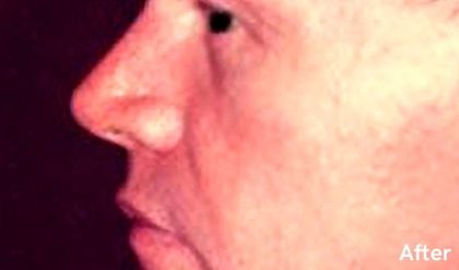 Rhinoplasty Male Before & After Patient #3039