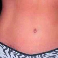 Tummy Tuck Before & After Patient #3078