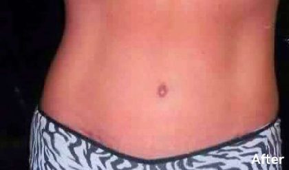 Tummy Tuck Before & After Patient #3078