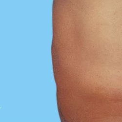 Tummy Tuck Male Before & After Patient #3090